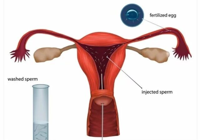 Artificial insemination IUI